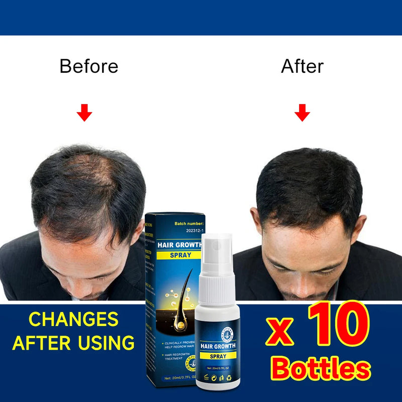 Hair growth essence spray anti-hair loss scalp treatment improvement of hair loss treatment alopecia areata seborrheic alop