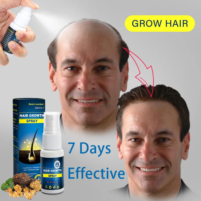 Hair growth essence spray anti-hair loss scalp treatment improvement of hair loss treatment alopecia areata seborrheic alop