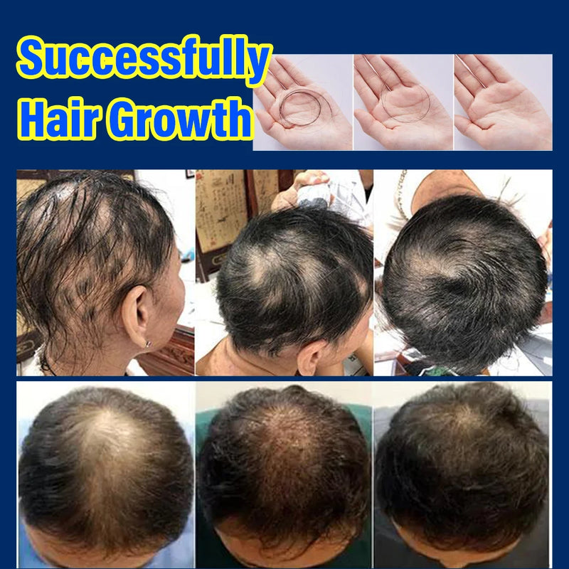 Hair growth essence spray anti-hair loss scalp treatment improvement of hair loss treatment alopecia areata seborrheic alop