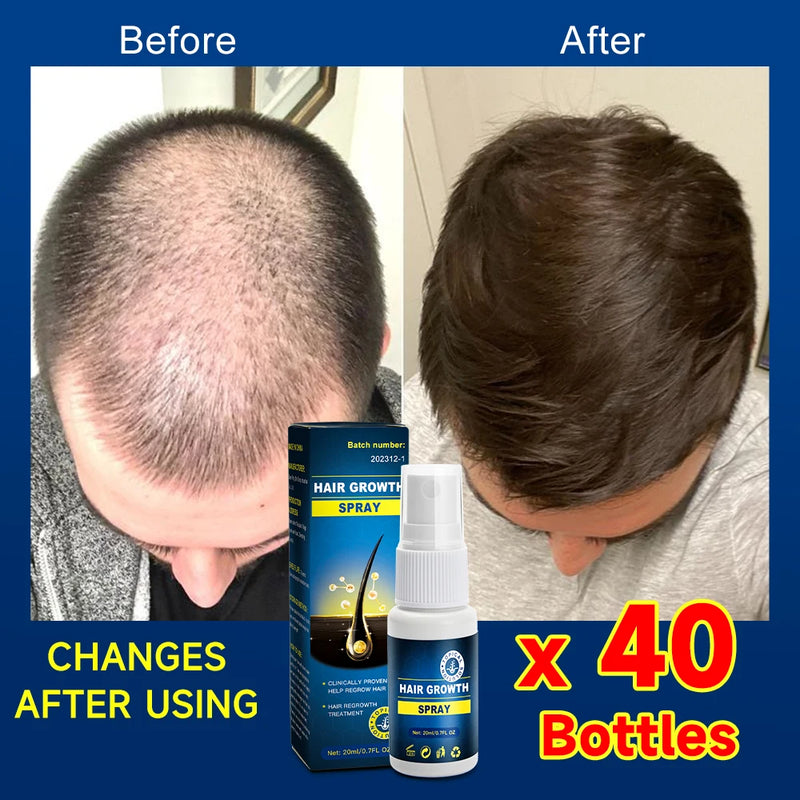 Hair growth essence spray anti-hair loss scalp treatment improvement of hair loss treatment alopecia areata seborrheic alop