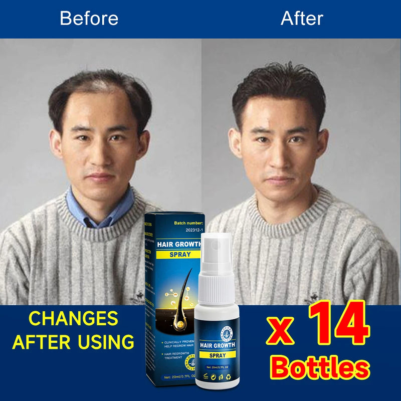 Hair growth essence spray anti-hair loss scalp treatment improvement of hair loss treatment alopecia areata seborrheic alop